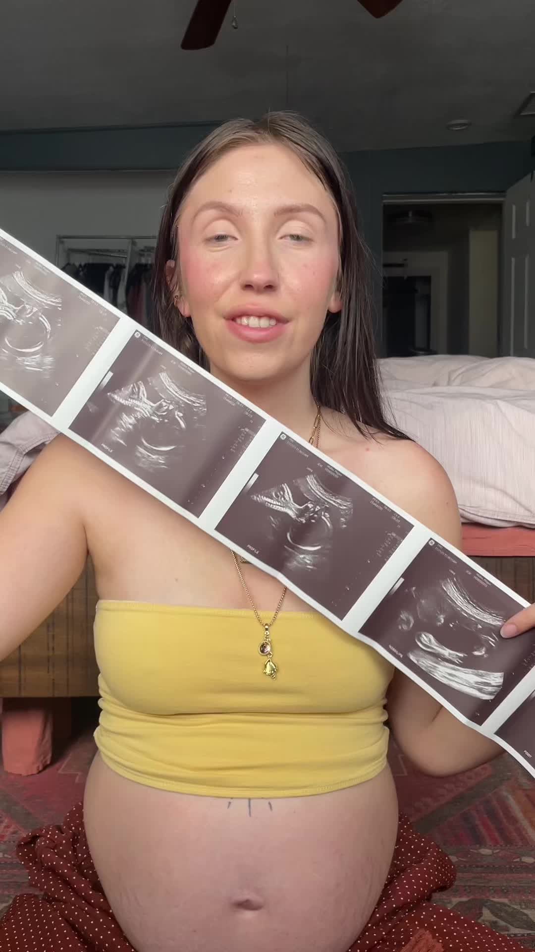 Abnormal anatomy scan findings for baby number three at 22weeks pregnant 🤰🏼 #creatorsearchinsights #anatomyscan #22...