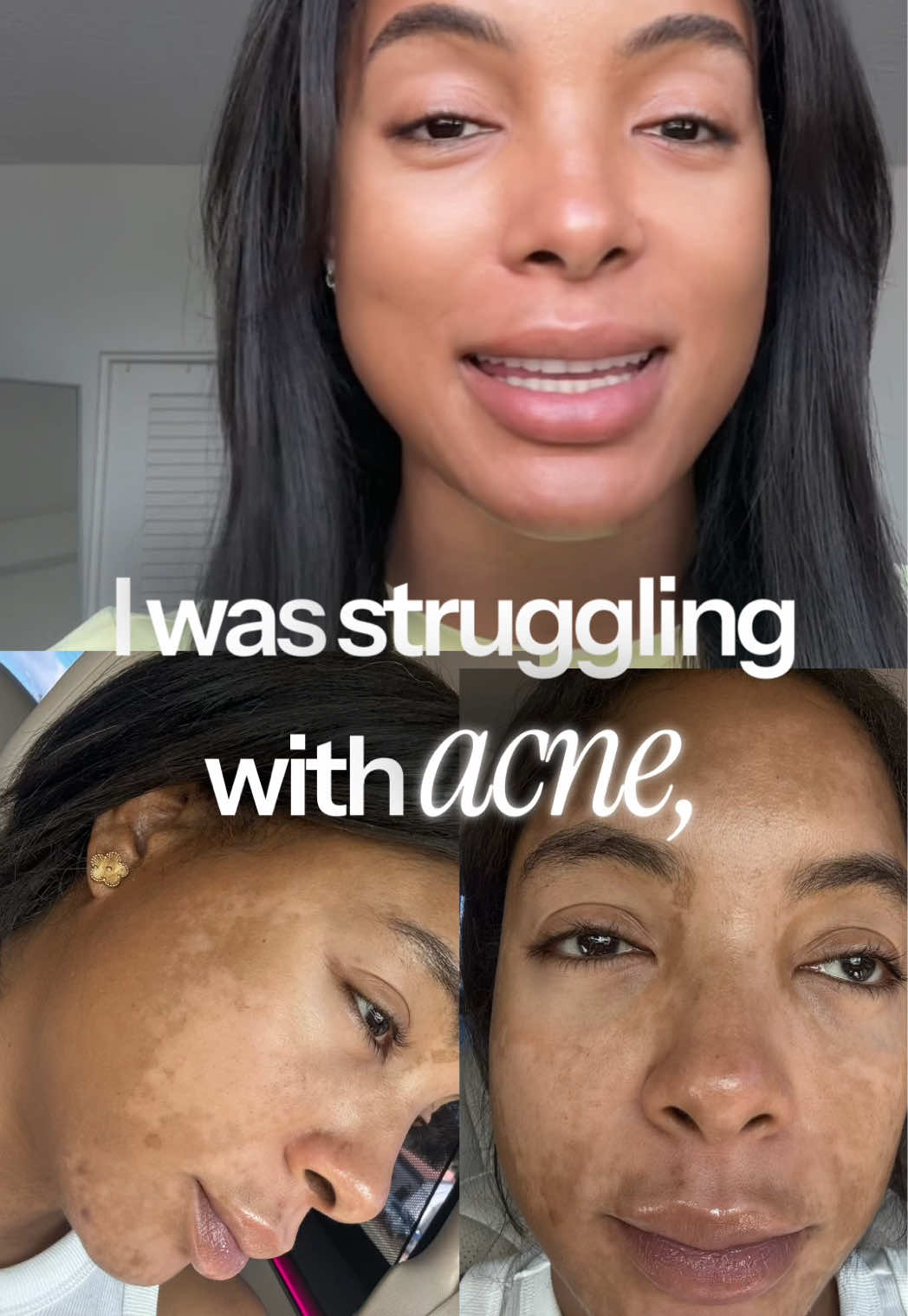 @HENCHA BEAUTY COLLECTIONS POV: You finally find a skincare routine that actually works. ✨ My skin went from acne, da...