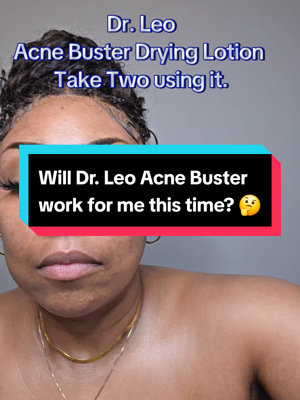 @Dr.Leo-USA Acne Buster Salicylic Acid Drying Lotion helps clear Acne and bumps, fast flattens Acne, and fades Acne s...