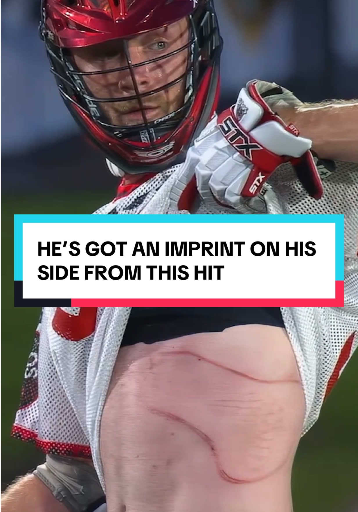 Jack Rowlett is an absolute WARRIOR for this… 😳💪🥍 #lacrosse #lacrossehighlights #pll #hit #ouch #defense #defensem...