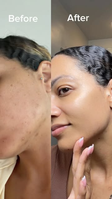 If you have dark spots and sensitive skin, right now is the BEST time to pick up this @dalba_global Vita Toning Serum...