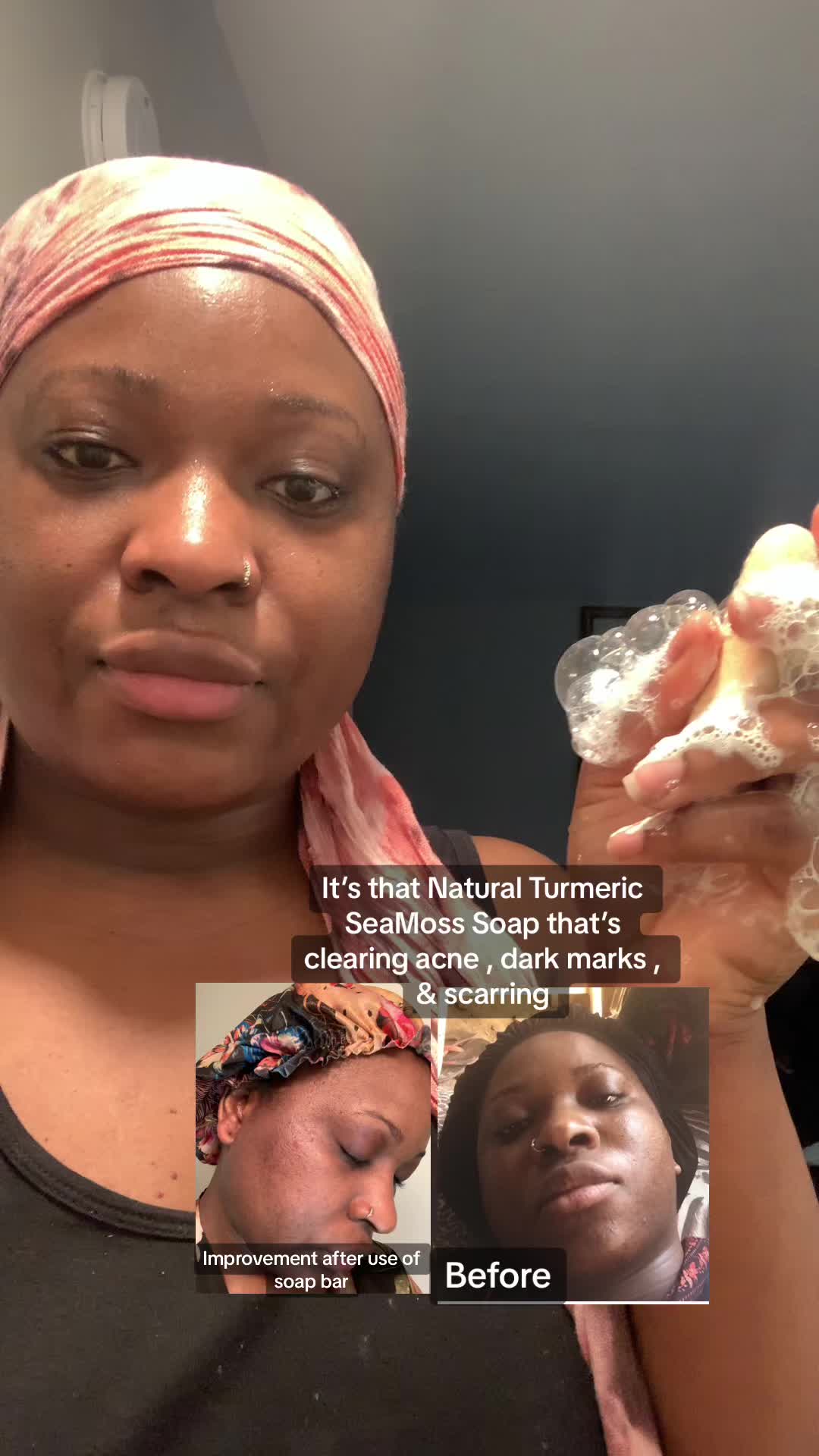 The Miracle Turmeric Soap Bar that is helping so many! Struggling with dark spots, acne, hyperpigmentation, or dark u...