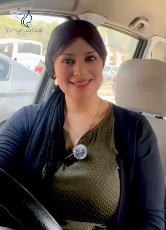 Natural Botox result
