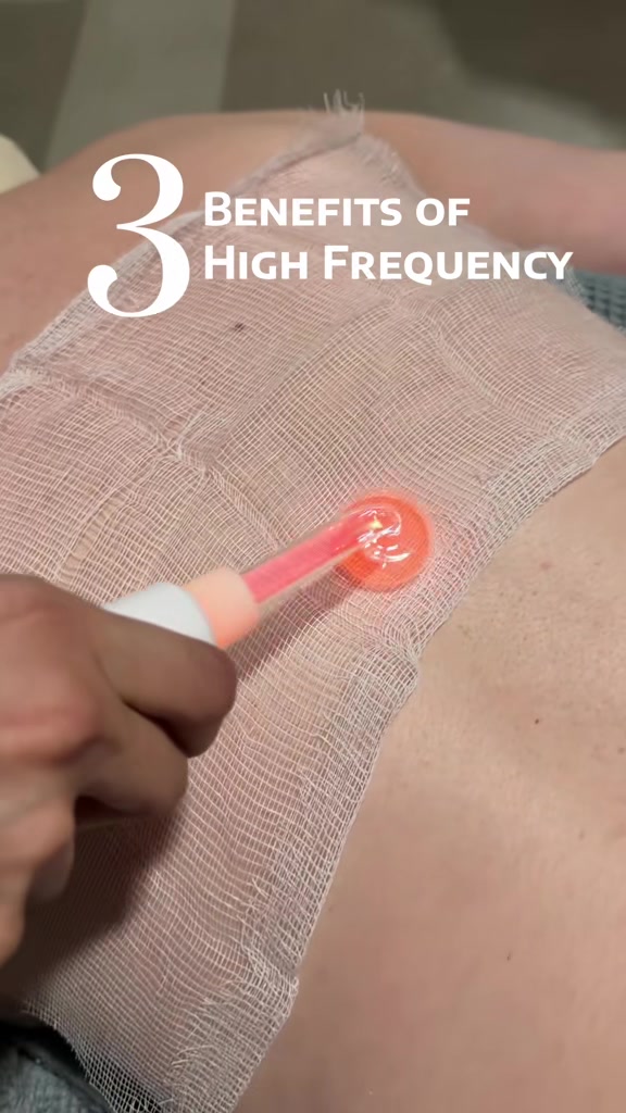 Bacne is way more common than we think and high frequency is the only way to go🤏🏻 #highfrequencywand #backacne #med...