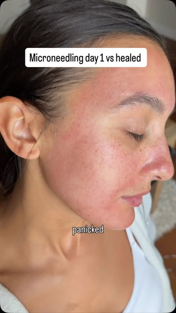 Nobody warned me about the first three days after microneedling. 😩😩 Day 1, I was red, what felt like a minor sunbur...