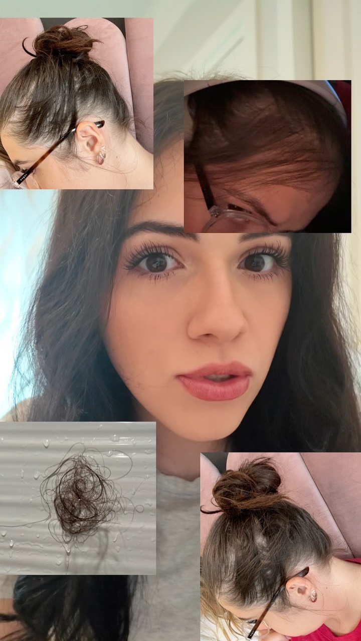 My hair started falling out in 9th grade, and after a year of experimenting, countless doctor visits, and over $14,00...